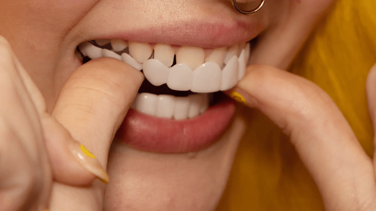 Omedelbar leendeförvandling med Snap-on Smile-fasader 6